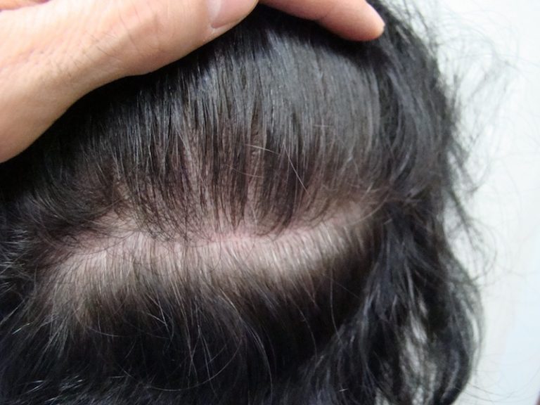 Raie Trop Marquée Chez La Femme: Des Solutions Existent - The Clinic