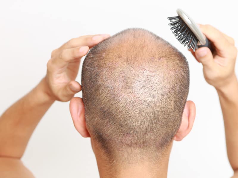 Does Hair Grow Back in the Donor Area After an FUE Hair Transplant Treatment 2 - The Clinic Paris