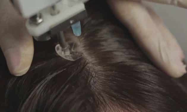 mesotherapie capillaire esthetical 15 15 youtube mesotherapie cheveux et led - The Clinic Paris
