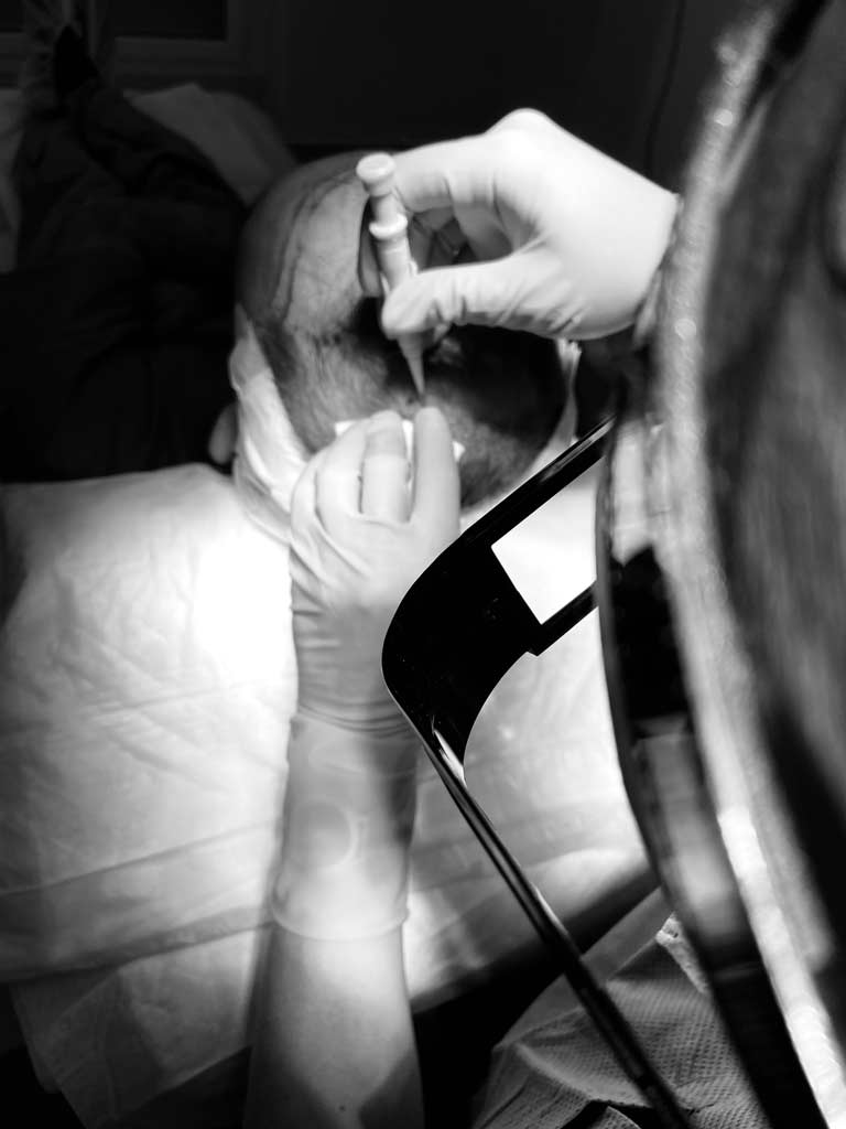 Implantation d'un greffon sur le scalp du patient