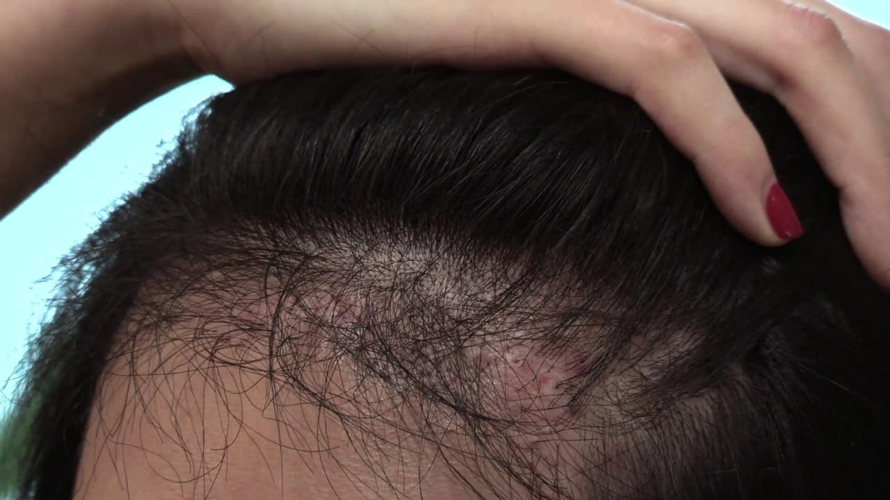 greffe cheveux raté