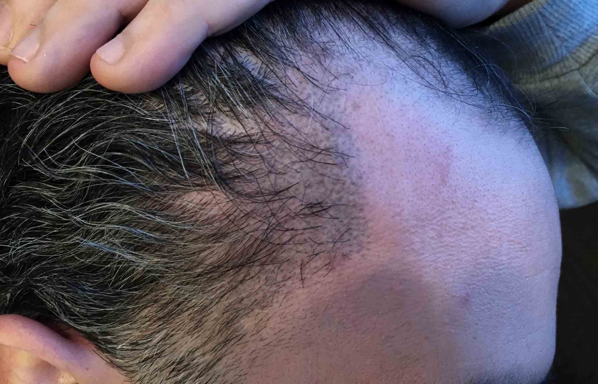 greffe cheveux raté