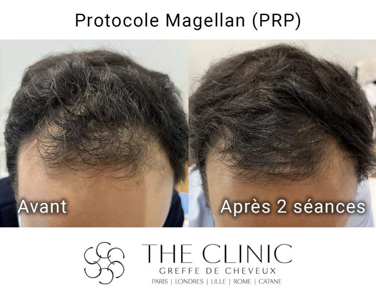 the-clinic-PRP-Magellan-avant-apres-48-RS