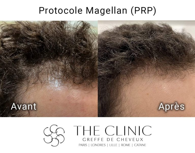the-clinic-PRP-Magellan-avant-apres-50-RS-Fr