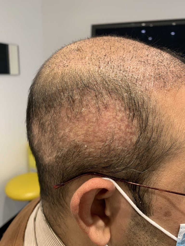 Greffe de cheveux ratee Turquie 1 - The Clinic Paris