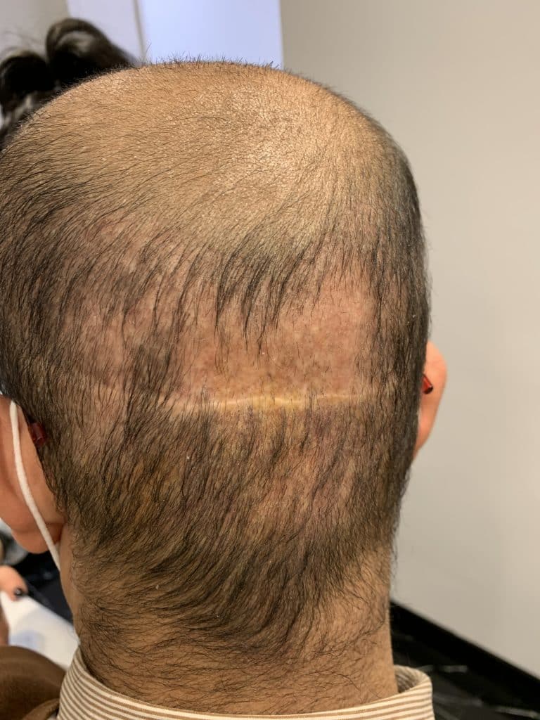 Greffe de cheveux ratee Turquie 2 - The Clinic Paris