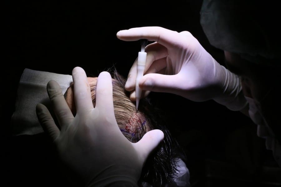 L'importance du suivi post-opératoire d'une greffe de cheveux